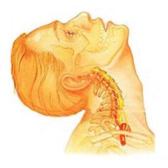 Osteocondrose da columna cervical