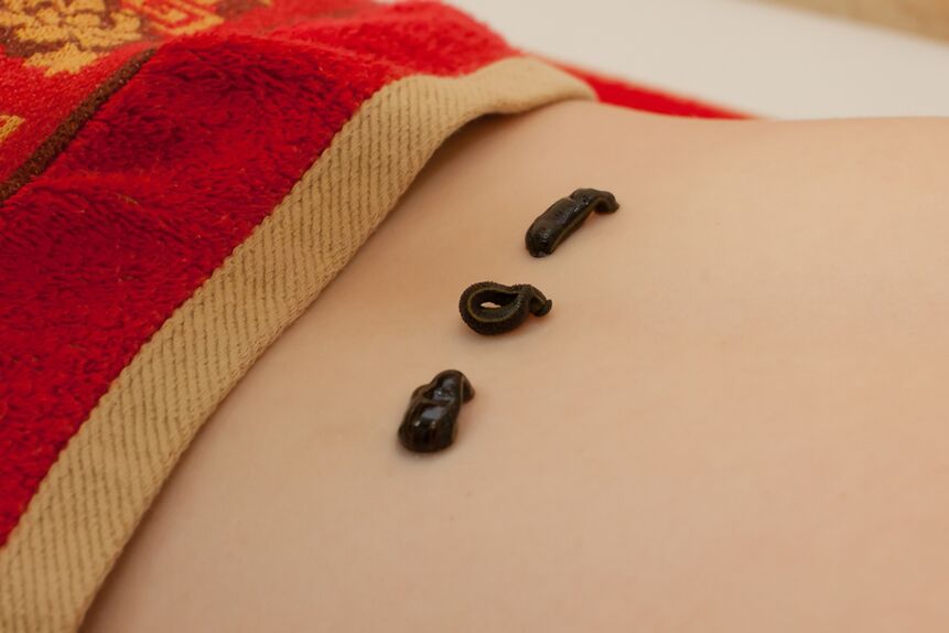 sanguijuelas na parte baixa das costas con osteocondrose